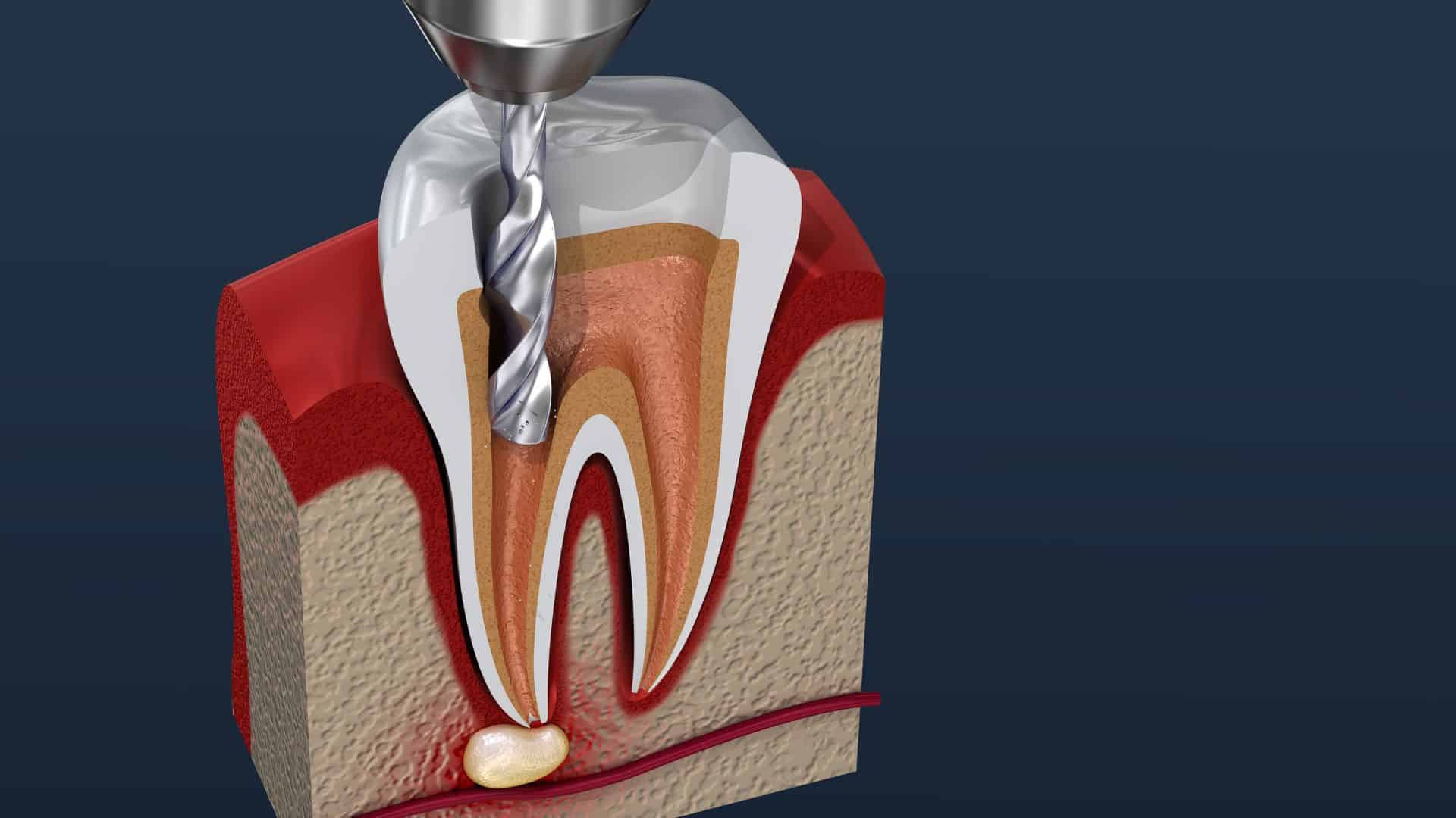 Cross-section diagram of tooth anatomy showing internal structure, pulp, and root canal system.