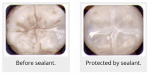 Dental sealant comparison showing tooth surface before and after protective coating application.