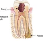Cross-sectional diagram of tooth anatomy showing decay, damage, pulp, and abscess formation.