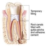 Tooth cross-section showing temporary filling and root canal filled with gutta-percha and sealer cement.