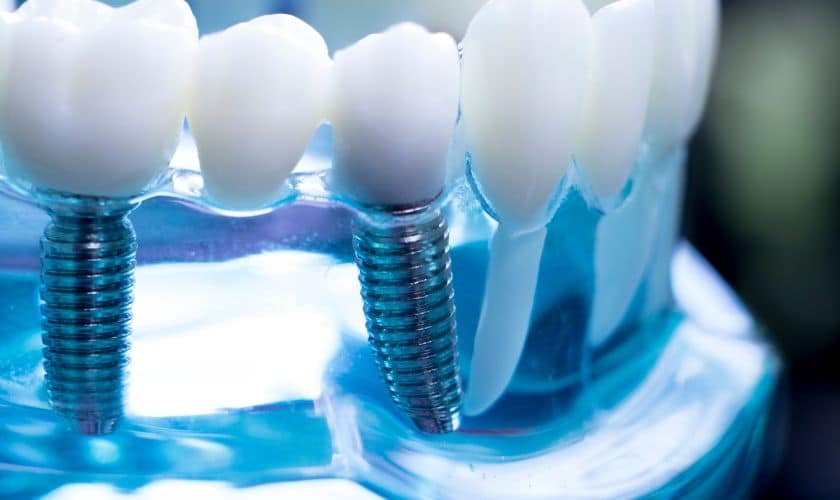 Dental Implants