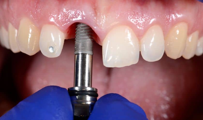 dental implants in Denver