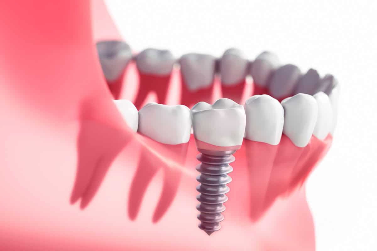 dental implants in Denver