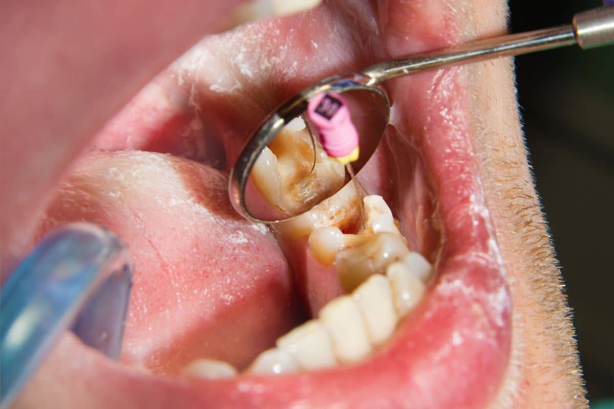 Dentist treating decayed tooth with dental instruments during clinical examination.