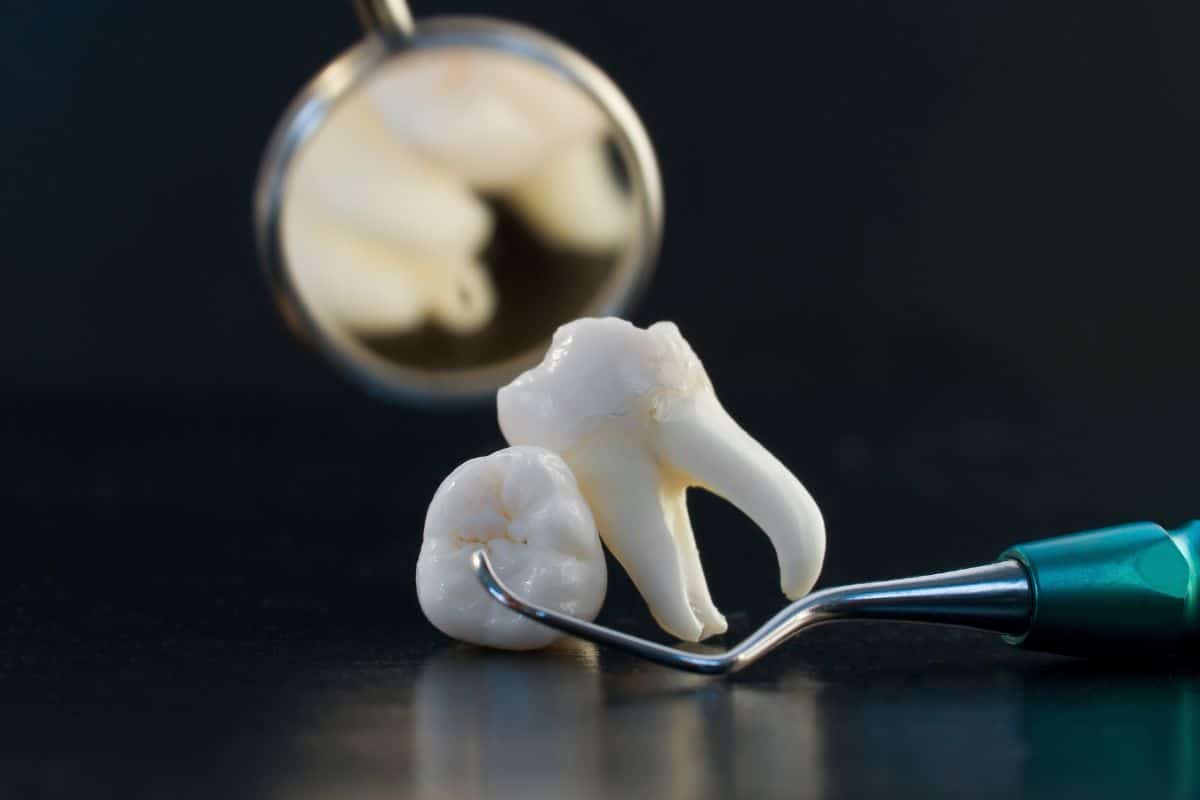 Treat Swelling After Wisdom Teeth Removal