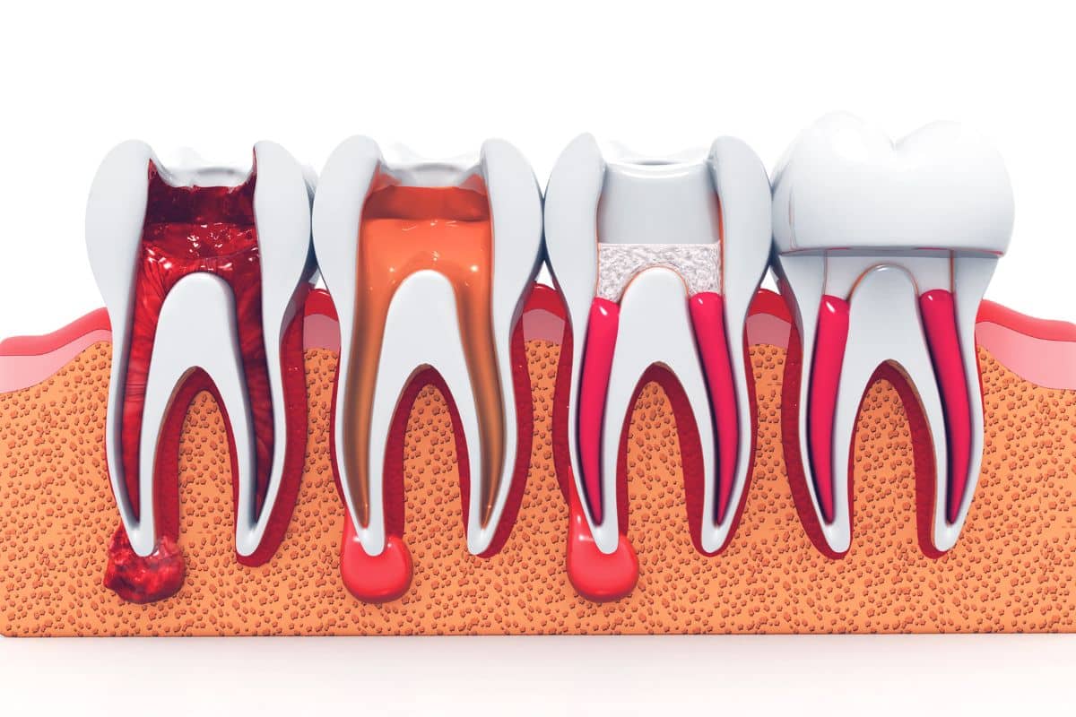 Symptoms of Jaw Infection After Root Canal Treatment