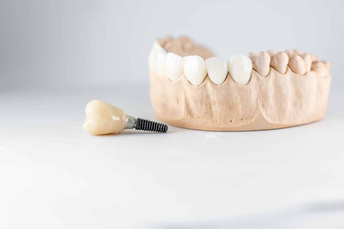 Can Dental Implants Be Removed