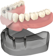 Dental implant model showing tooth replacement components and prosthetic restoration stages.