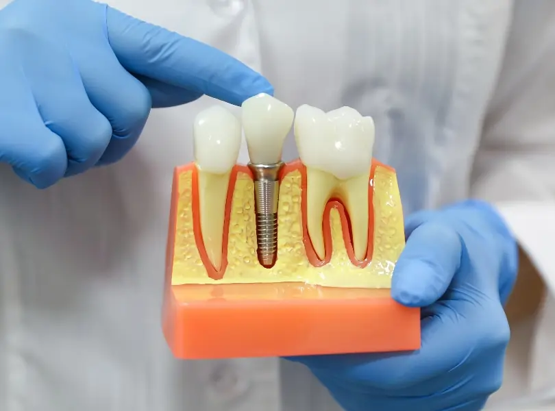 Dentist demonstrates dental implant model showing tooth structure and implant placement in gums.