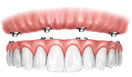 Dental implant prosthetic showing pink gum model with artificial white teeth crowns attached.