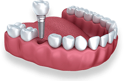Dental implant model showing tooth replacement procedure with crown and abutment screw placement.