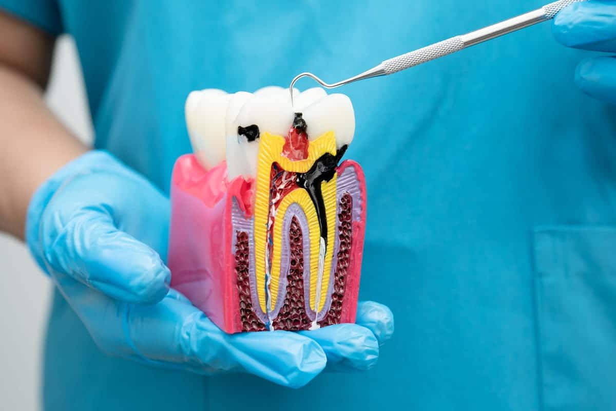 Are Root Canals Bad For Your Heart