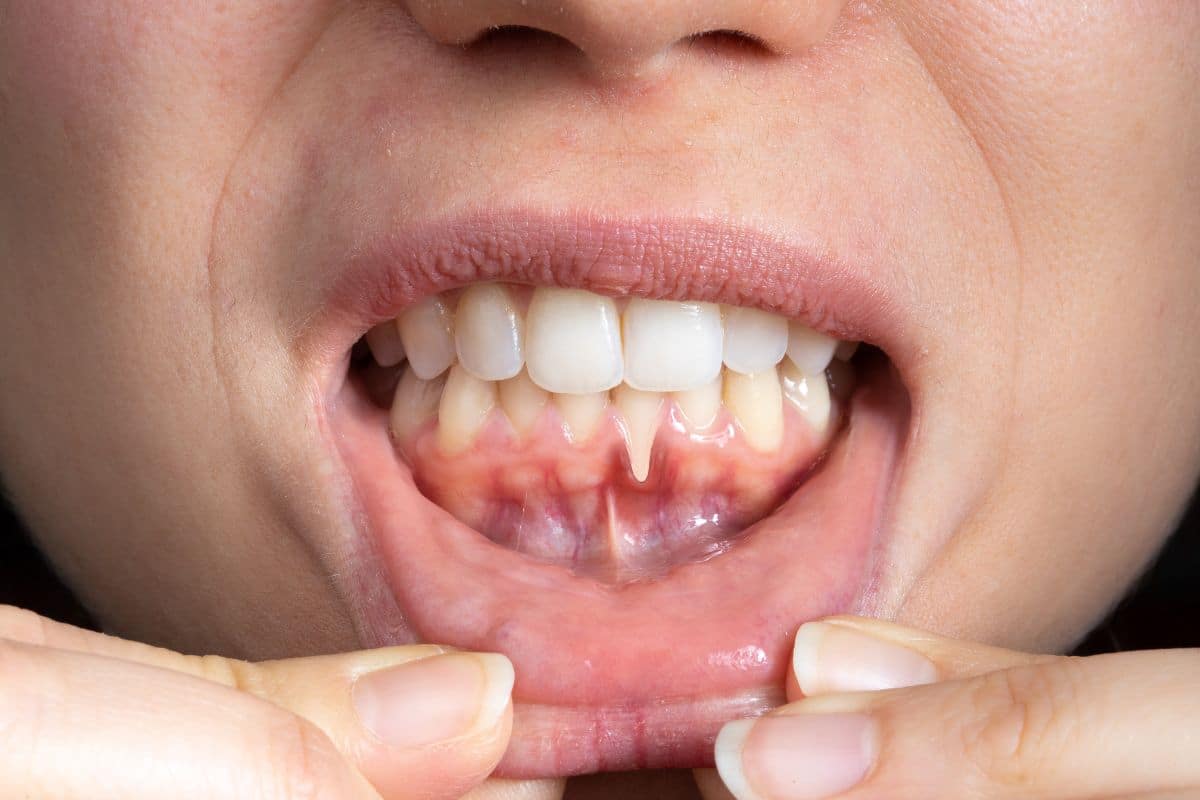 Receding Gum Treatment