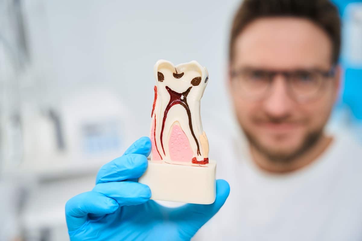 Do Root Canals Work for Cracked Teeth