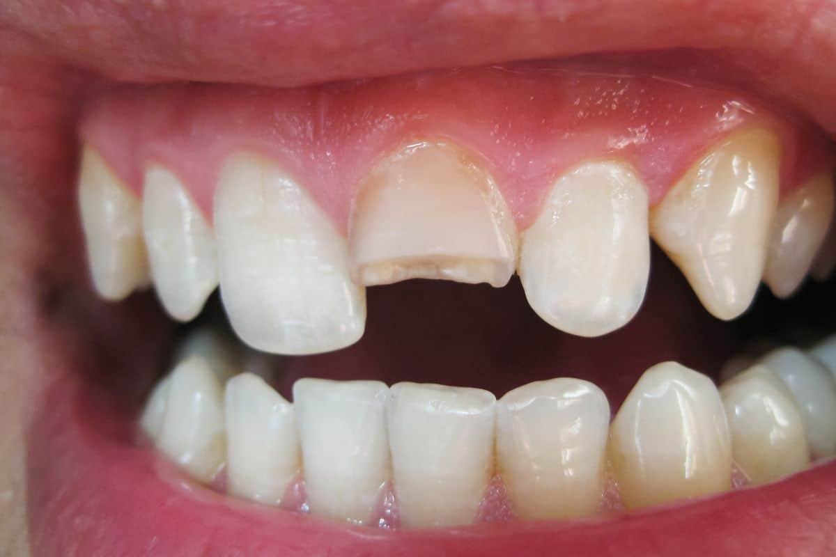 Can a Chipped Tooth Grow Back Naturally
