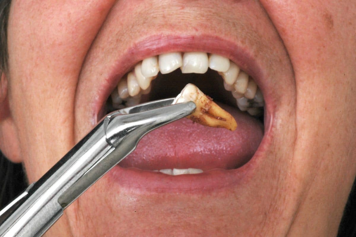 When to Stop Using Gauze After Tooth Extraction