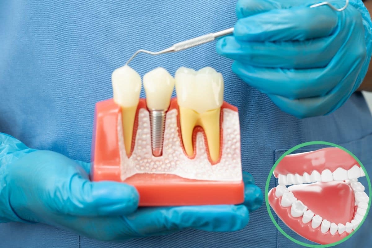Dental implant model showing natural tooth, implant with screw, and natural tooth comparison.