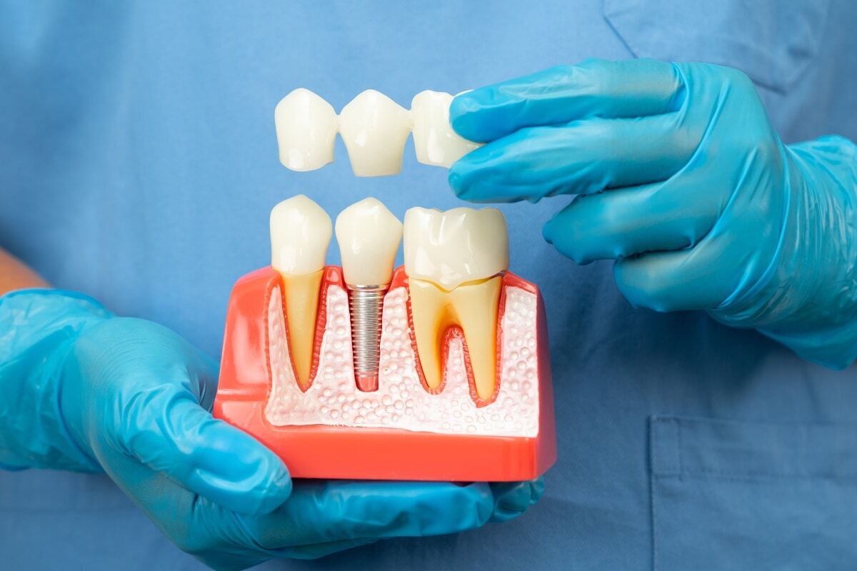 Dental implant model showing tooth crown, implant post, and natural teeth with abutment during patient consultation.