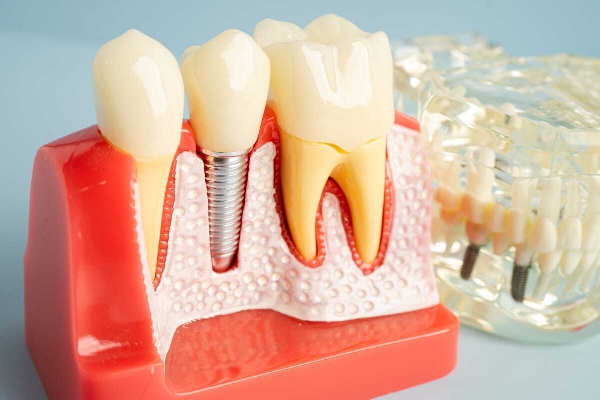 Dental implant model showing natural tooth, implant with screw, and tooth with root canal on red gum base.