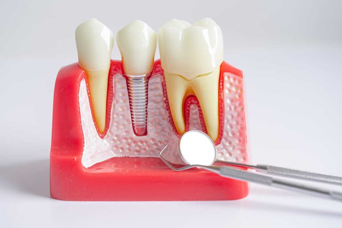 3D dental implant model showing tooth replacement options at dental office in Denver, CO.