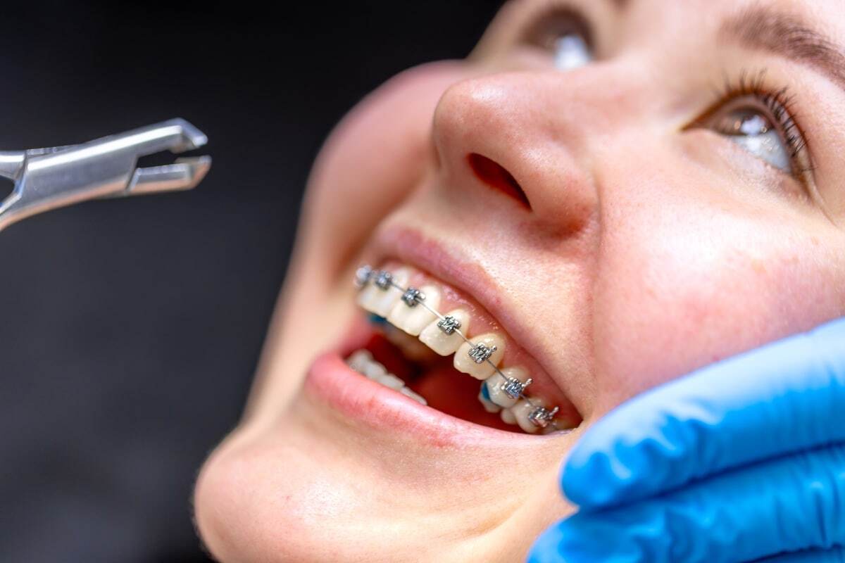Patient with dental braces receiving orthodontic examination during treatment in Denver dental practice.