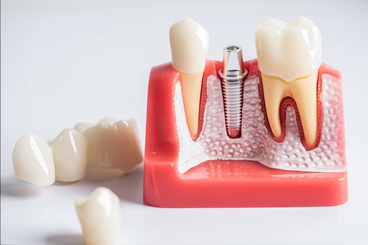 Smoking and Its Effects on Dental Implants