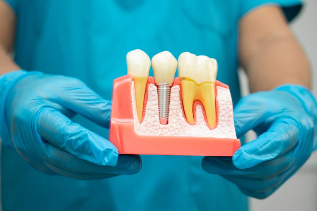 Facts About Dental Implants and How to Care for Them