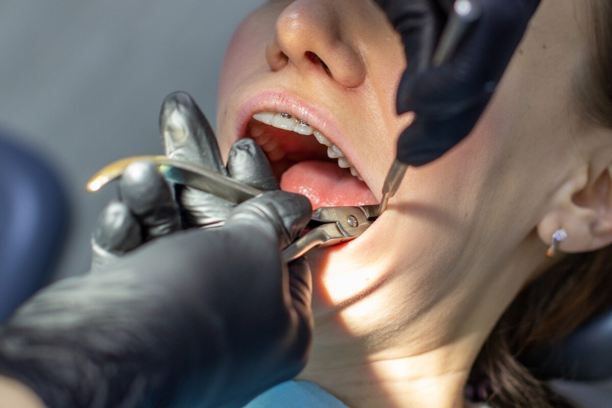 Wisdom teeth extraction procedure being performed on patient at dental office in Denver, CO.
