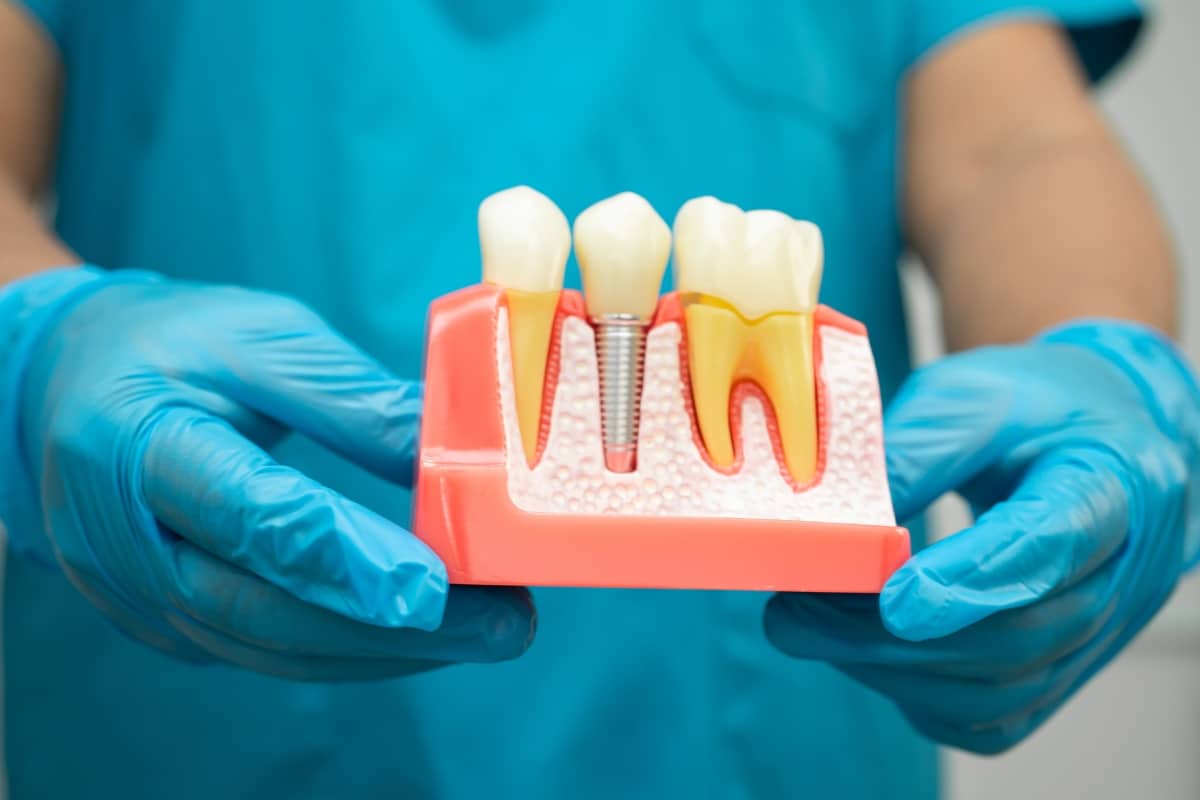 When Do Dental Implants Need to Be Replaced